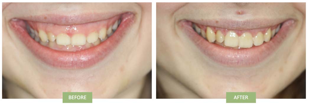  A before and after of a gingivectomy.