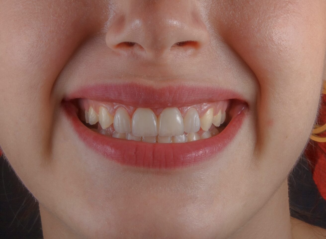 A woman smiling with swollen gums.