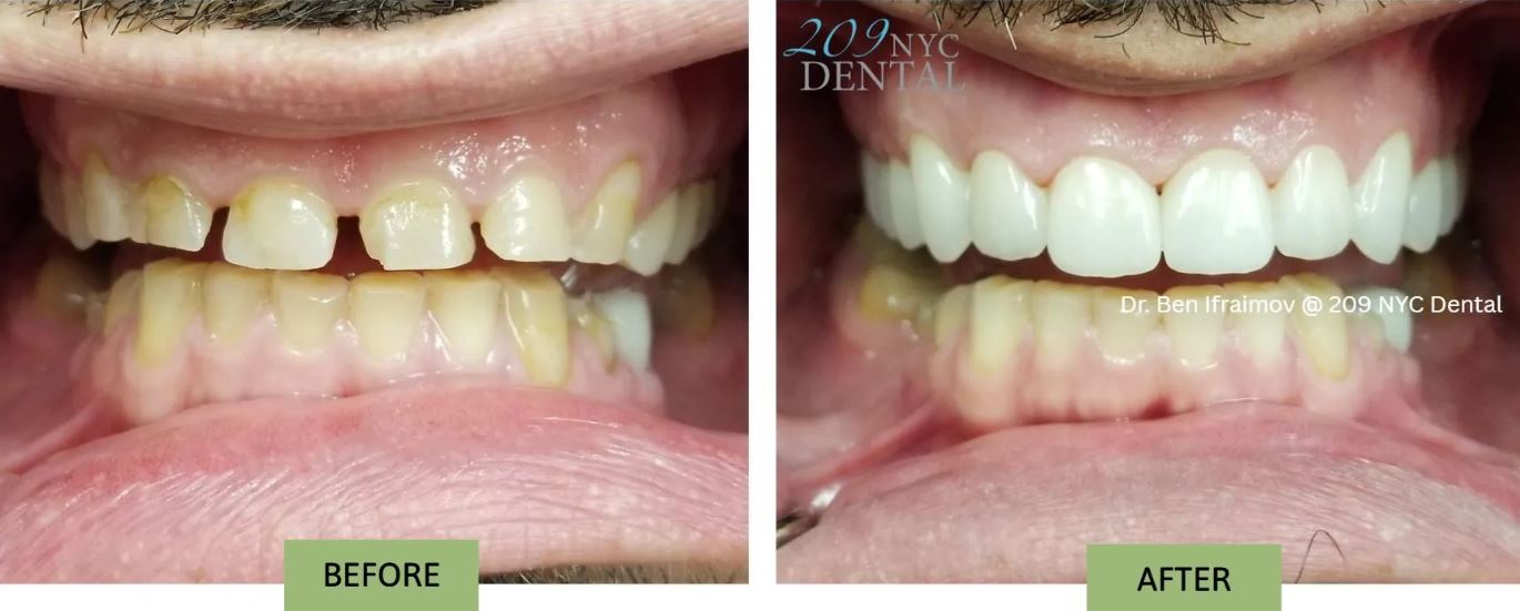 esthetic crown lengthening and veneers
