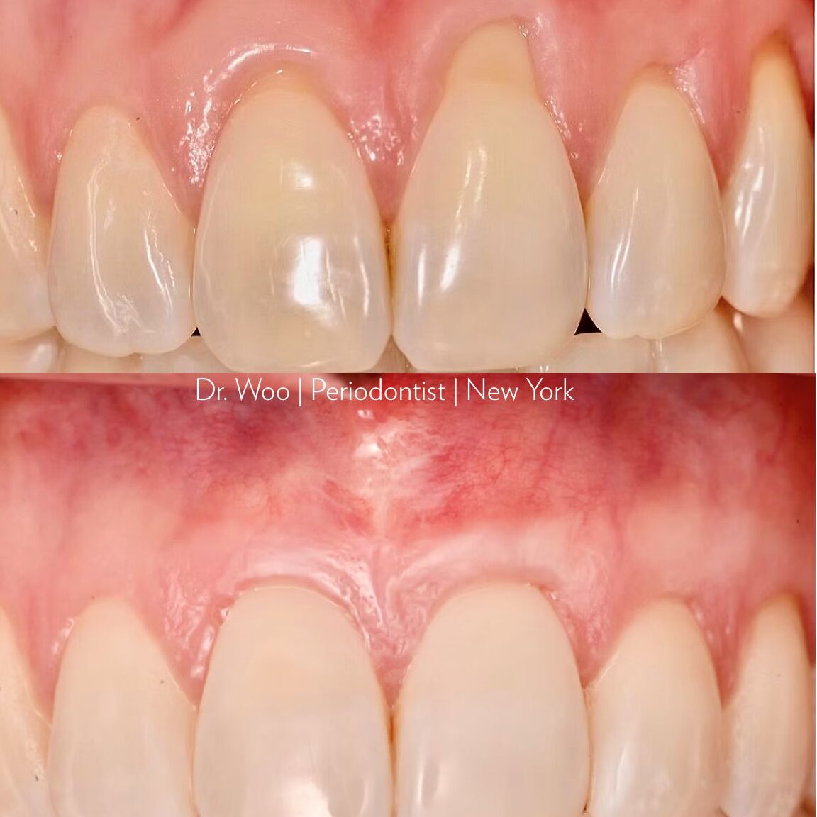 Clinical case showing advanced tissue grafting for root coverage by Dr. Hyun Woo