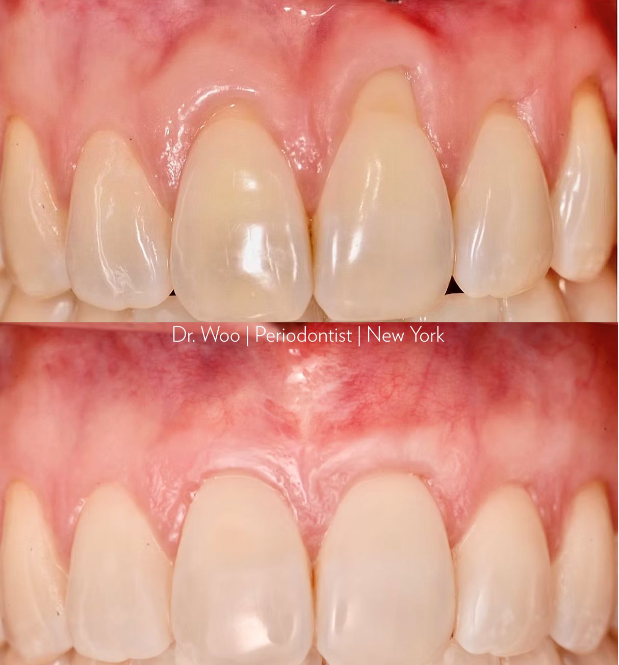 Soft tissue graft clinical case - Dr. Hyun Woo
