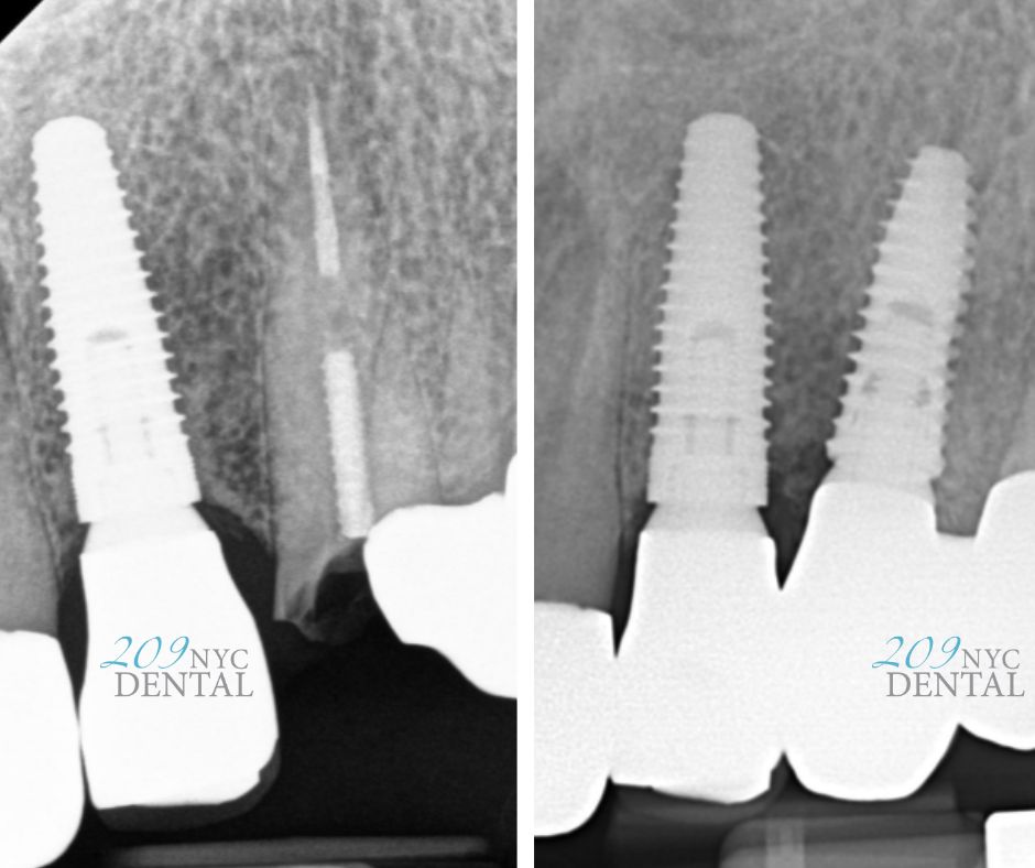 Clinical before and after X-ray of surgical dental implant placement by Dr. Jin Wang and prosthetic restoration by Dr. Dmitry Nikitayev at 209 NYC Dental.