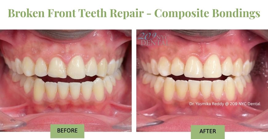 Chipped teeth repair with Composite Bondings as Dental Emergency Treatment for Chipped and Broken Front Teeth by Dr. Reddy at 209 NYC Dental.