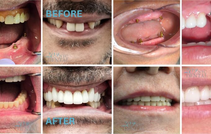 The Effects of Smoking on Dental Implants