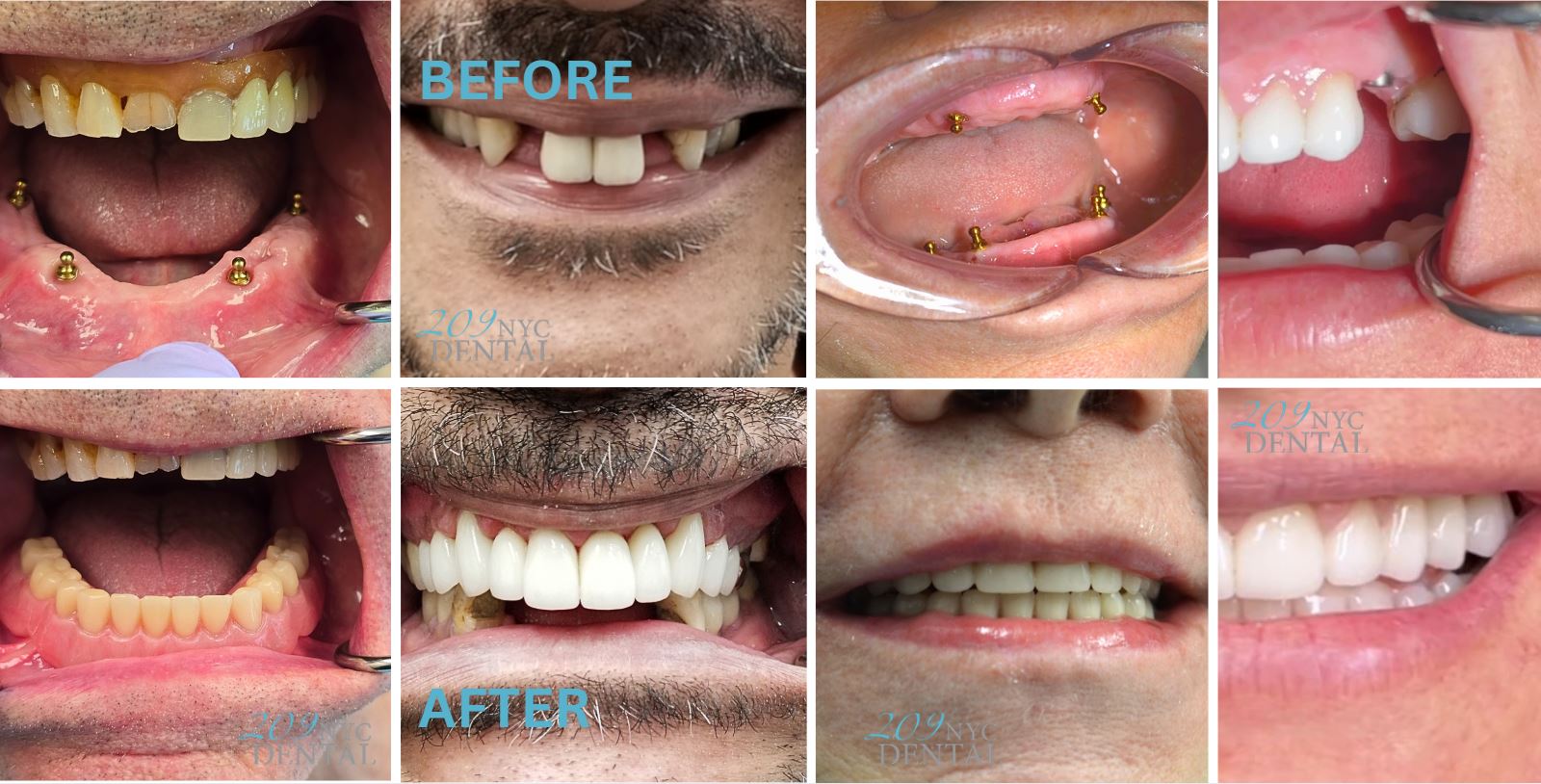 can you get 2nd hand smoke from vapes Can I Vape After Wisdom Tooth Removal? main image 0