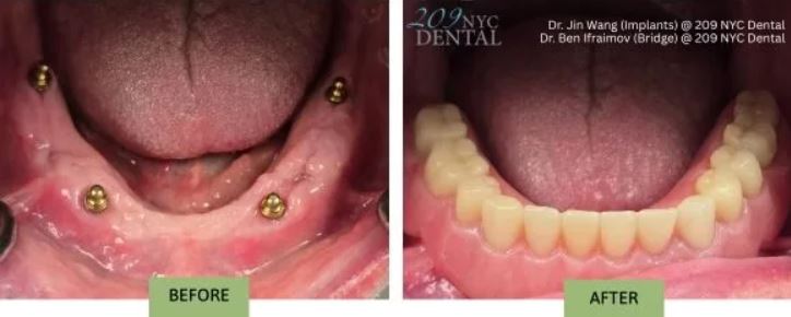 Dental Care in Midtown East NYC: full implant denture