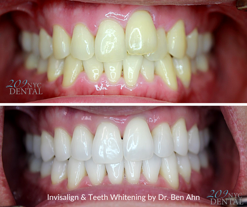Invisalign discounts and special deals in Manhattan NYC