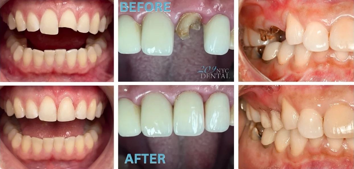Before and after of a cracked tooth and crown repair by our NYC emergency dentist
