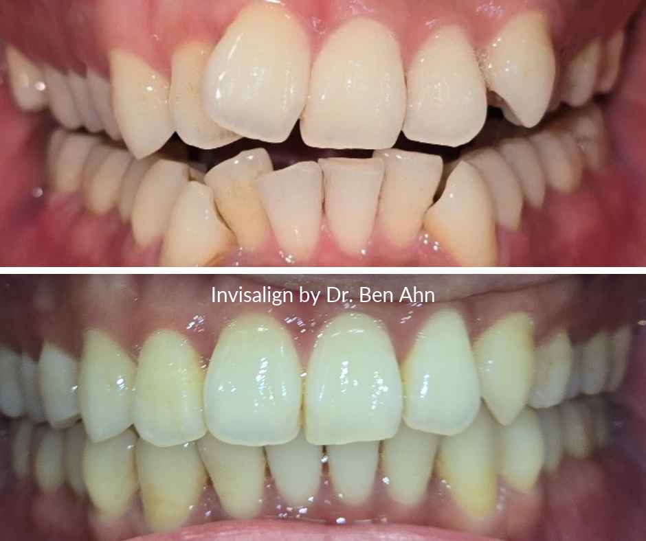 Before and after results of crooked teeth correction. Results delivered by Dr. Ahn in 209 NYC Dental.