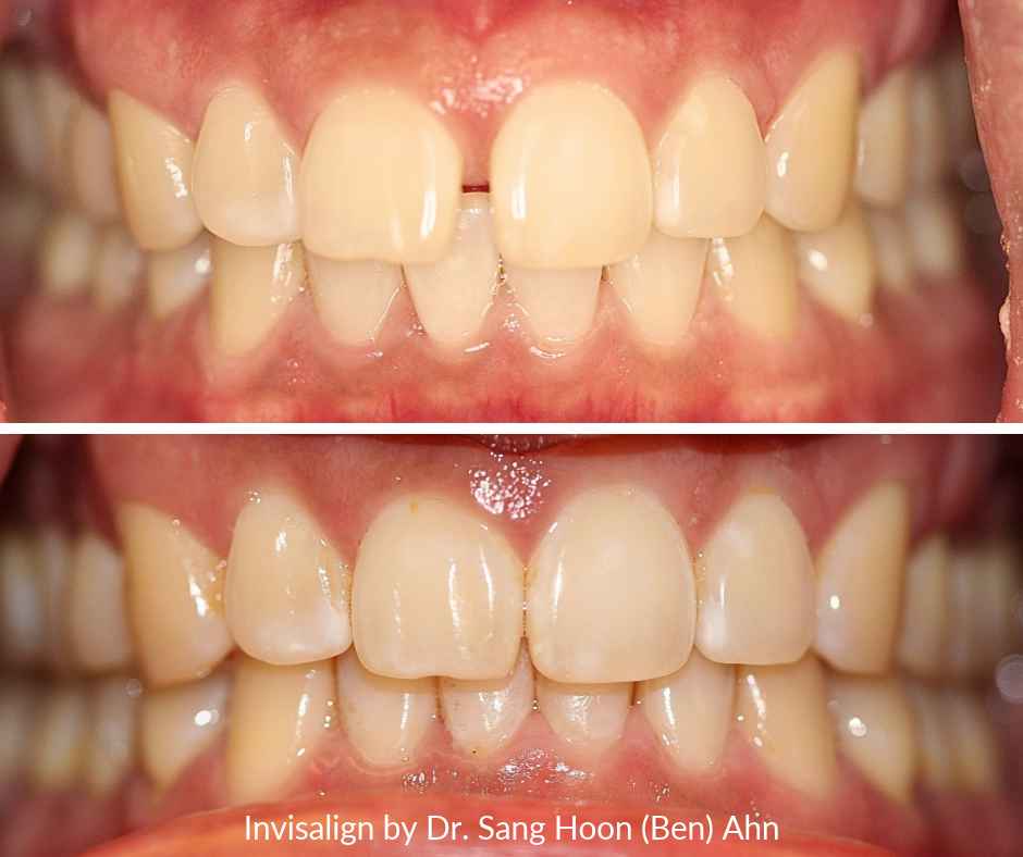 Invisalign for gaps before and after