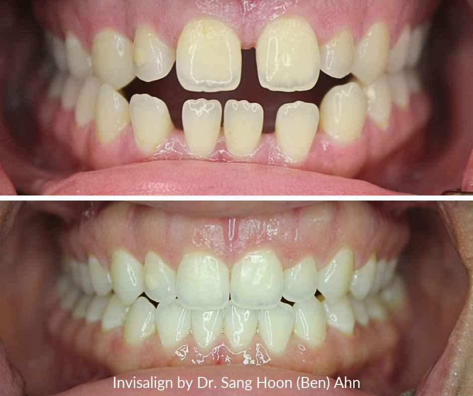 Invisalign for gaps before and after photos