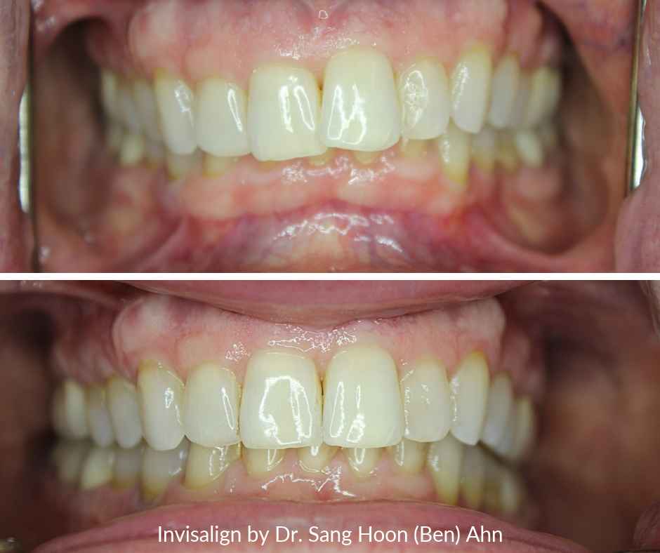 Invisalign for overbite