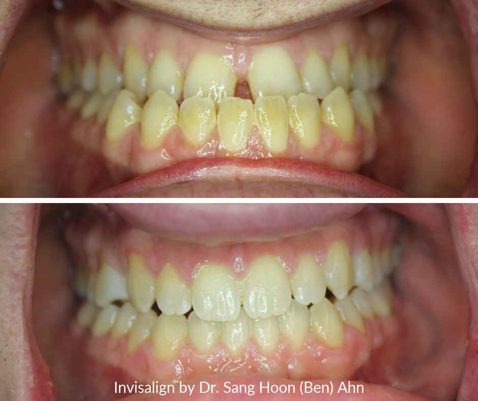 Invisalign Dentist NYC Before and after underbite realignment