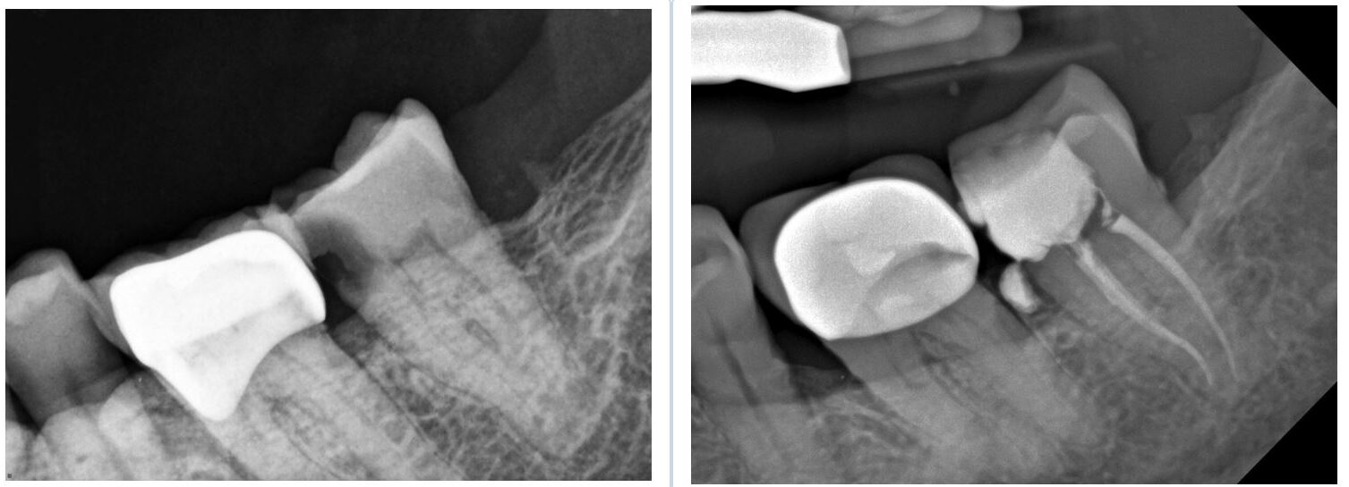 molar tooth - root canal treatment